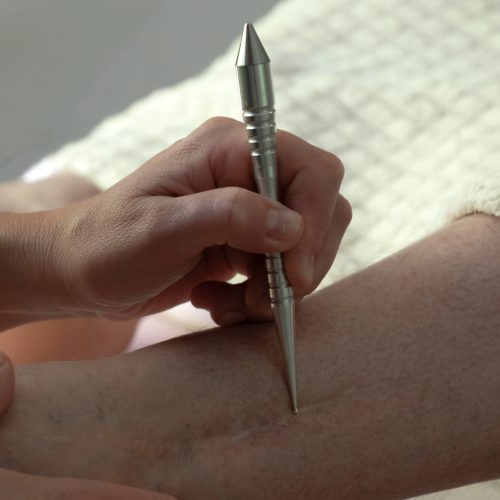 Narbenentstörung Narbenentstörung